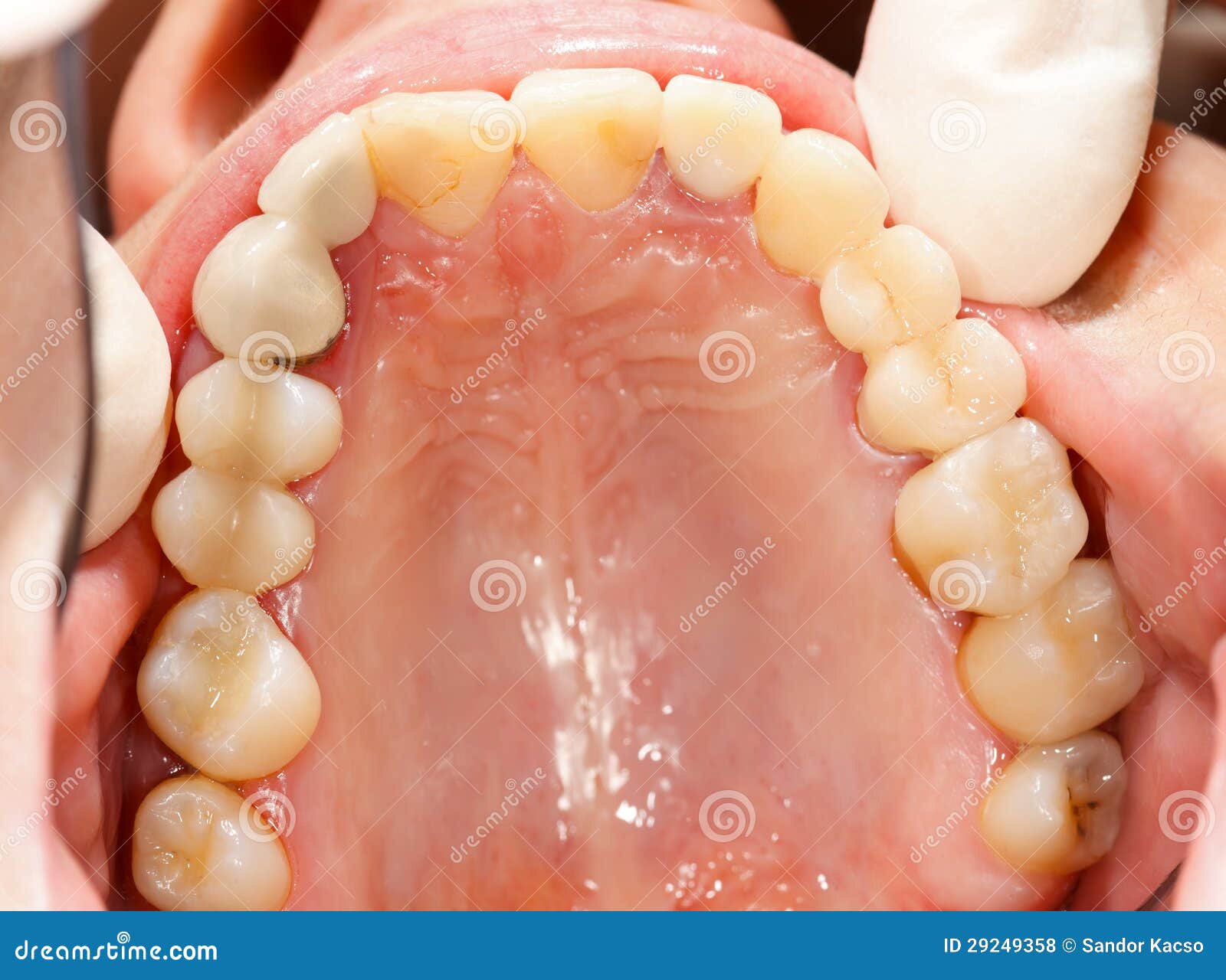 Metaloceramics Vs. Pressed Ceramics Stock Photo Image of dentistry