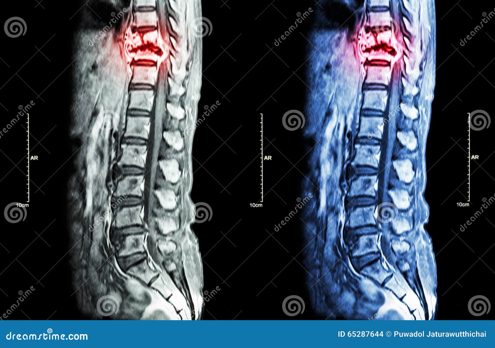 Metastasi Della Spina Dorsale Fotografia Stock Immagine Di Anatomia Cavo