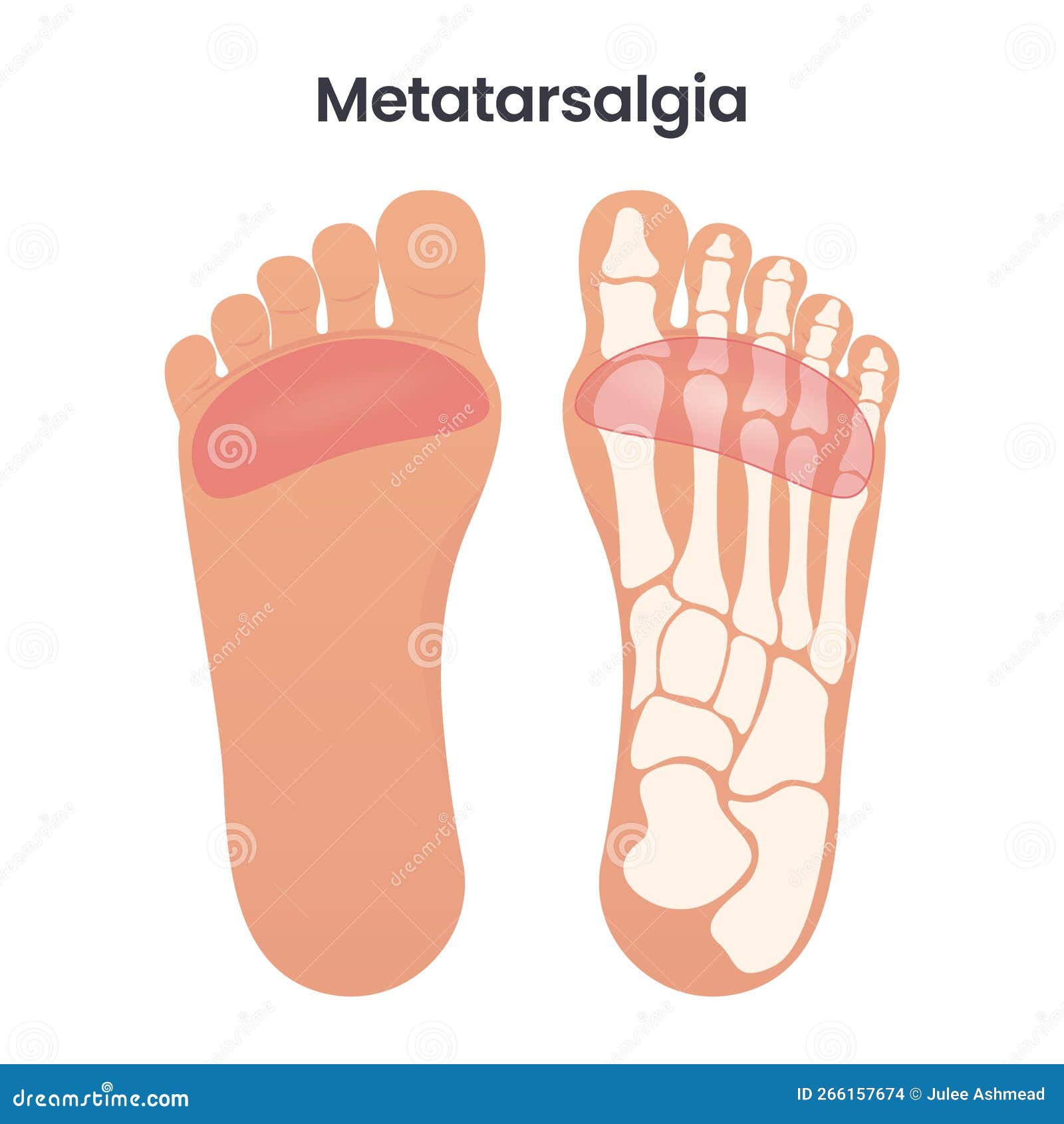 Metatarsalgia Pain In The Ball Of The Foot Medical Educational Vector