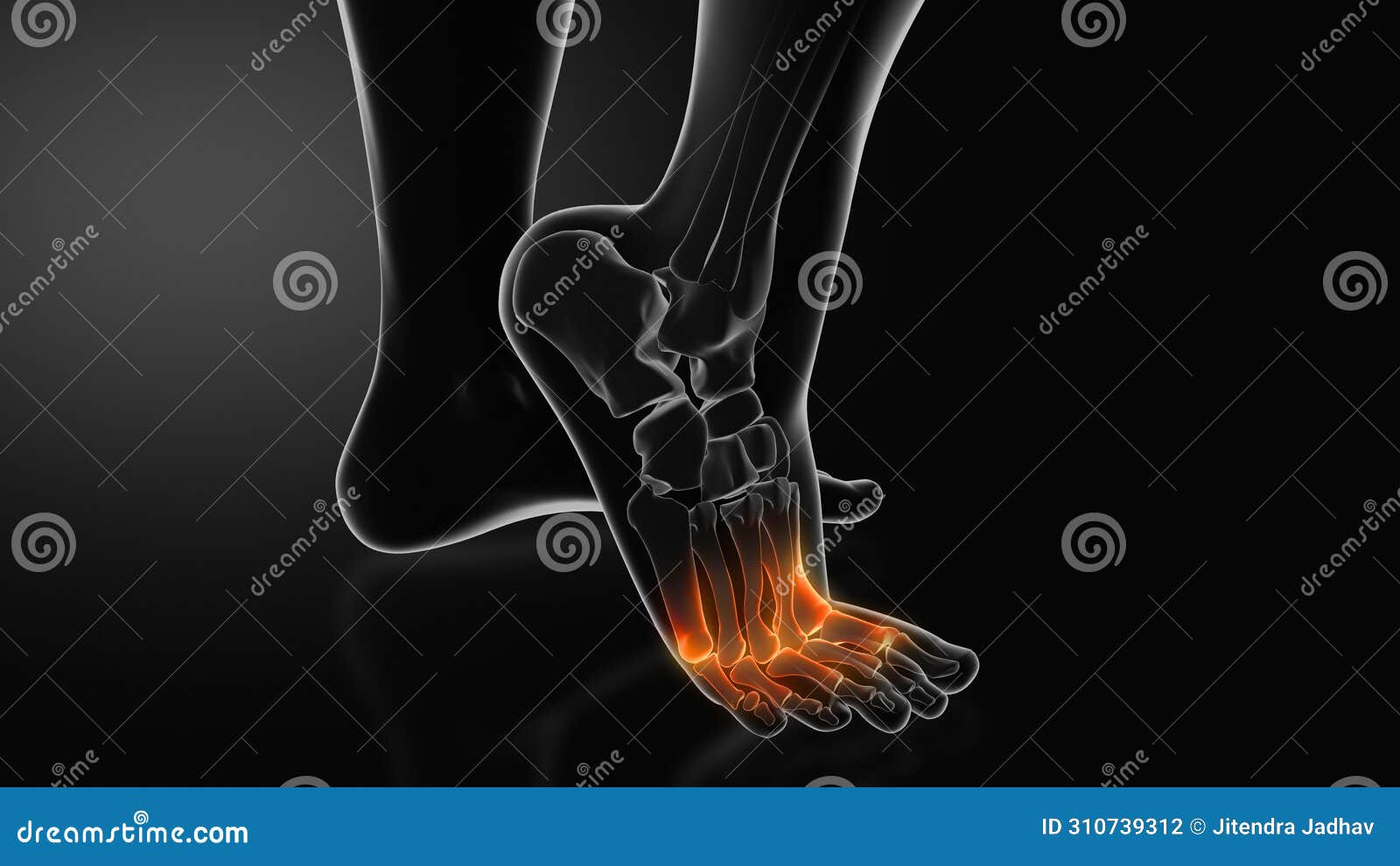 metatarsalgia or ball of foot pain