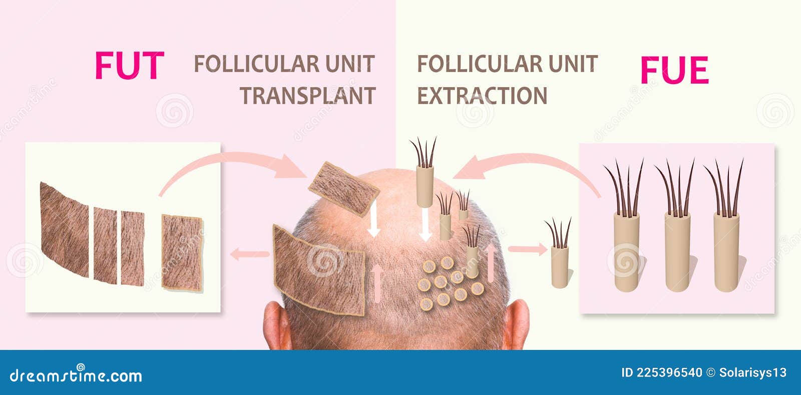 methods of hair transplantation fut vs fue with infographic s of .