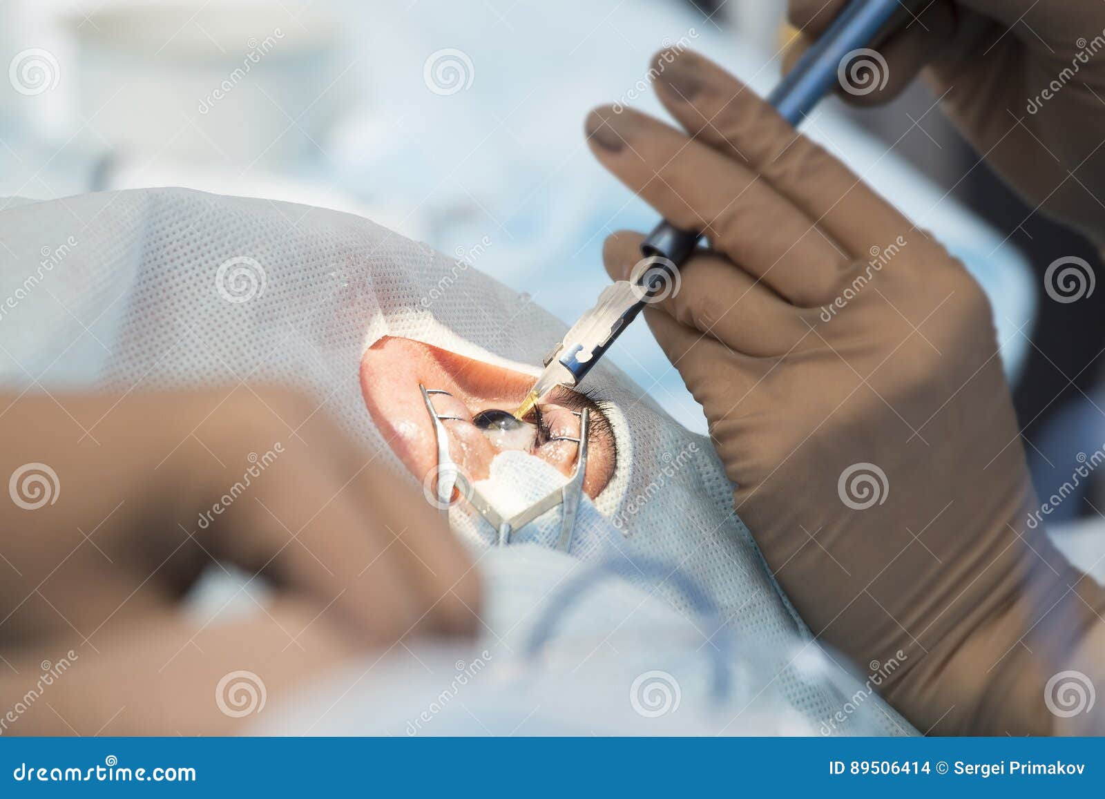 Metodo chirurgico sostituibile della lente cristallina. Correzione del laser per visione - chirurgia di oftalmologia per gli occhi