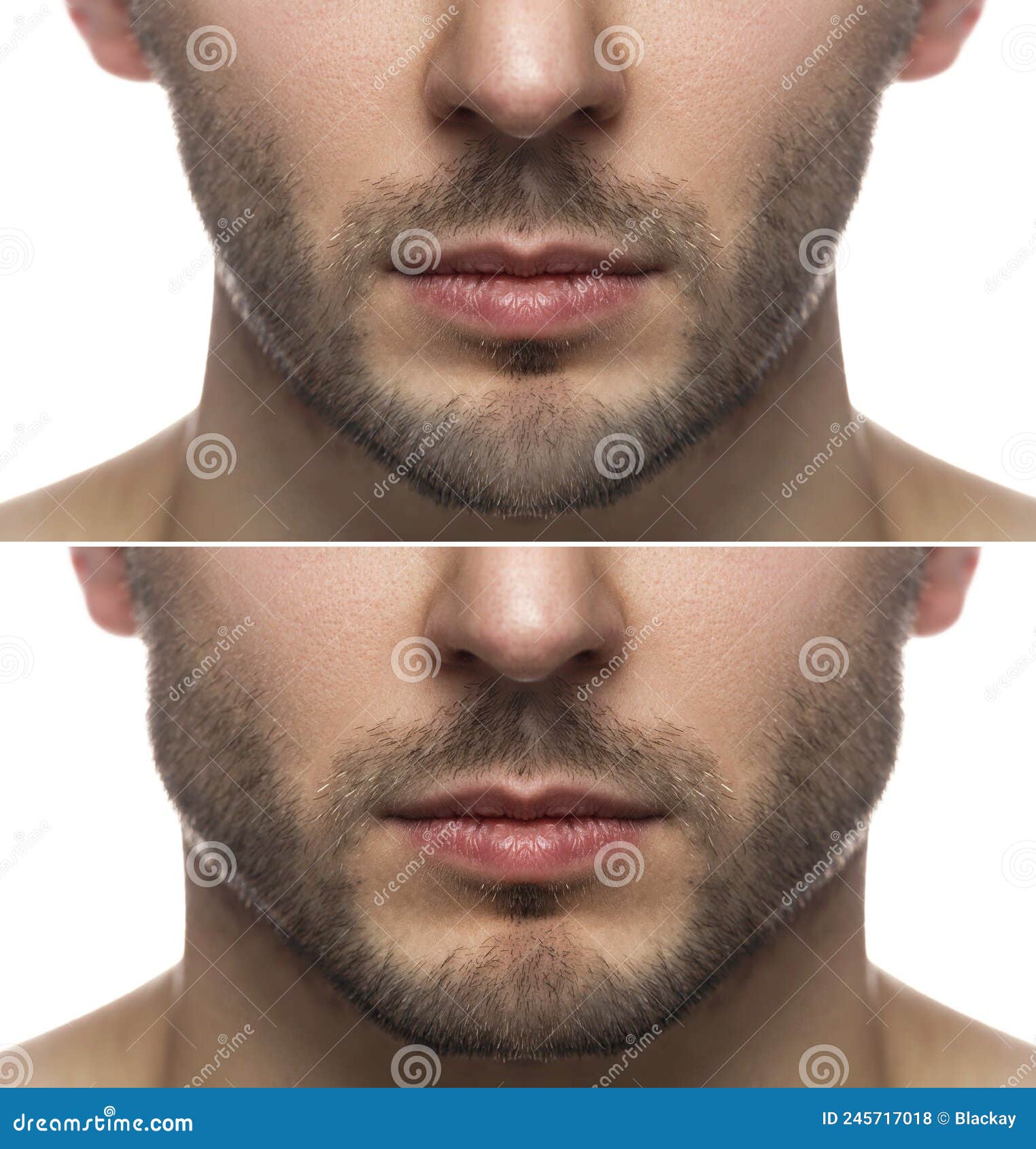 Mewing Exercises. Result of a Jawline Reshape Stock Photo - Image