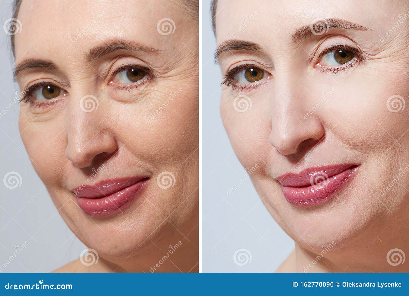 anti aging facial before and after)