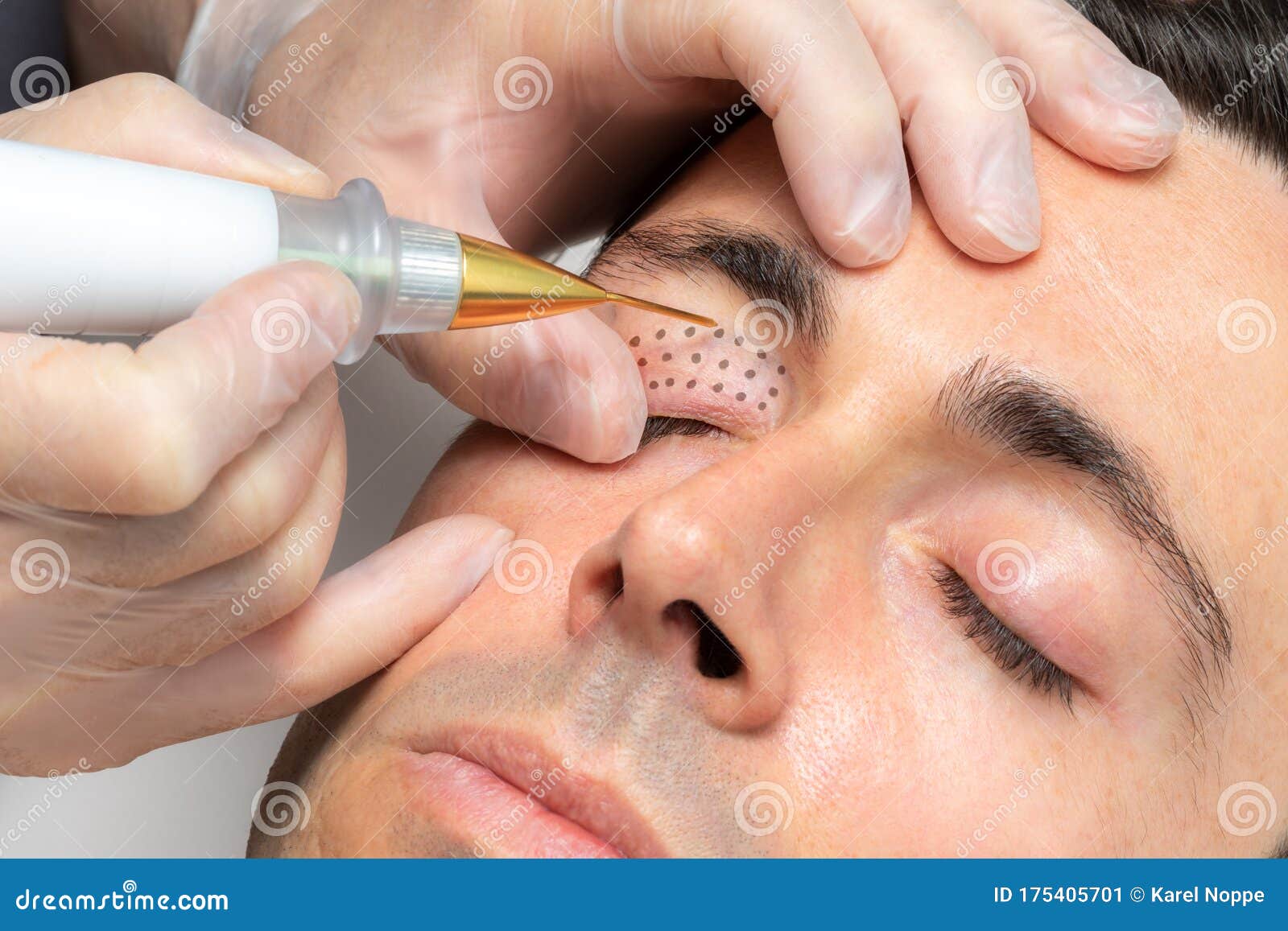 middle aged man having laser plasma pen therapy on eyelids