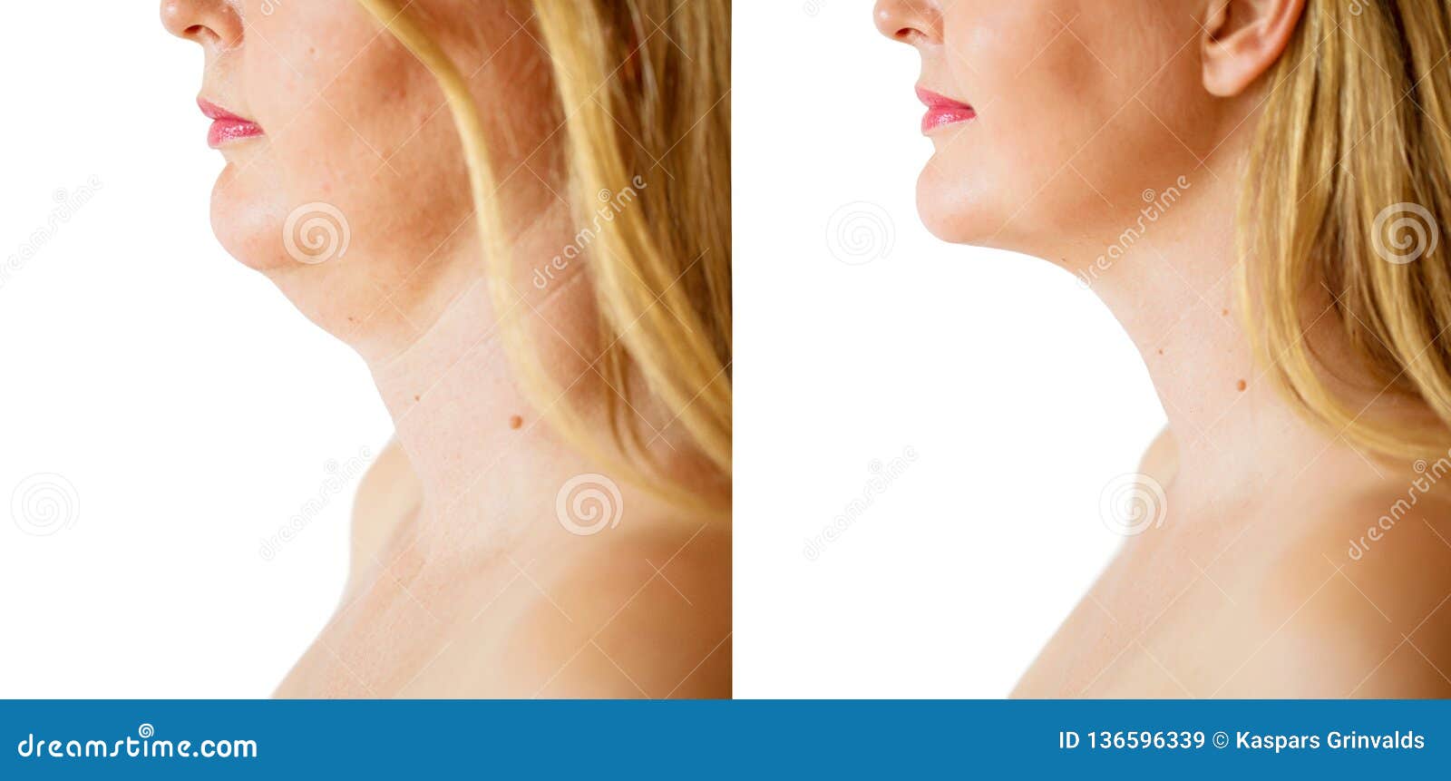 woman before and after chin fat correction procedure