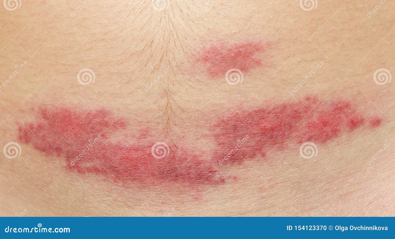 Midge Mosquito Bite. Reaction To the Bite of Midges. Allergy. Danger of  Insect Bites in the Summer. Red Spot at the Bite Site Stock Photo - Image  of bloodsucker, midges: 154123370