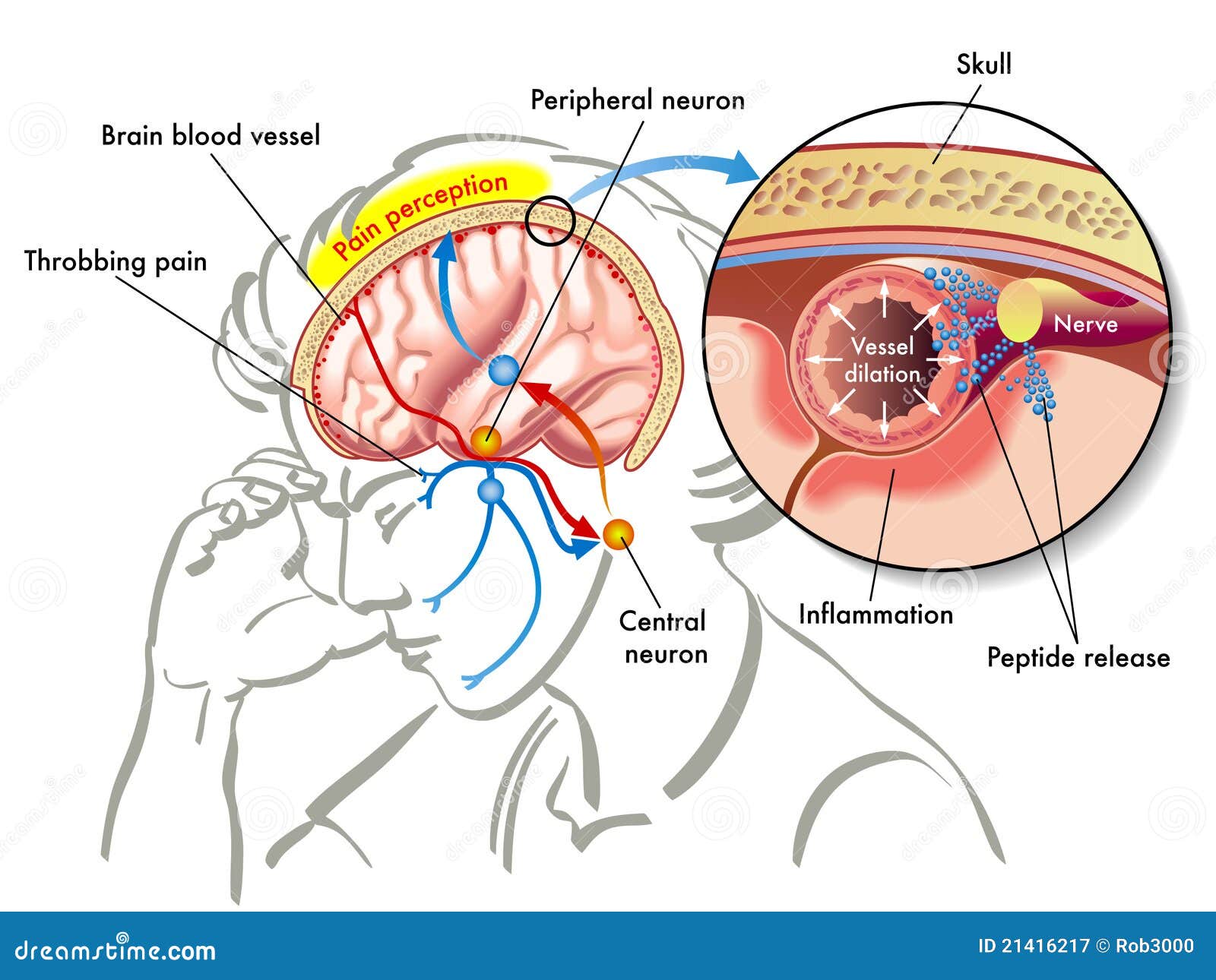 Migraine stock vector. Illustration of cells, head, hormonal 21416217