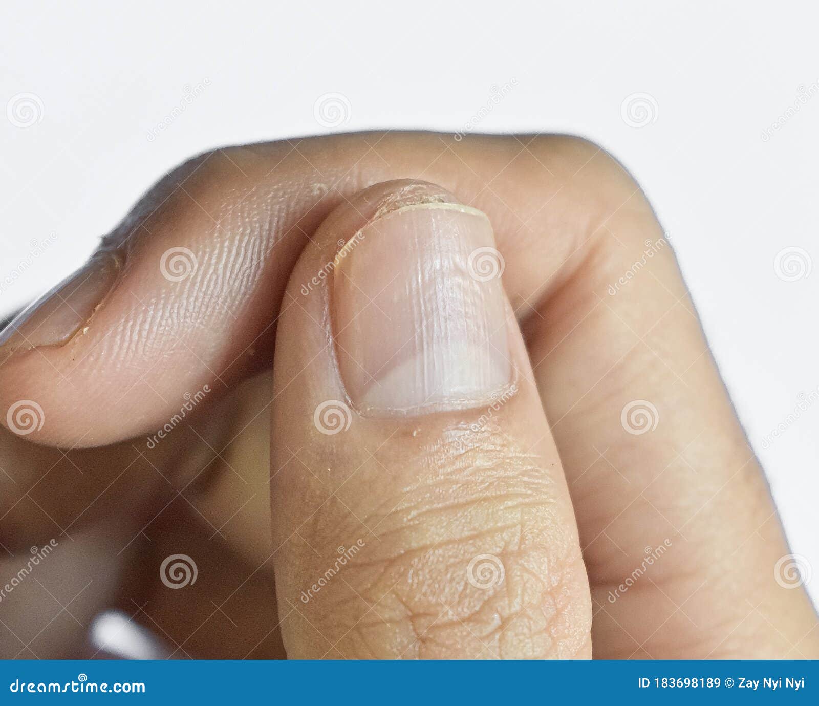 mild nail pitting and vertical lines at right thumb of southeast asian, chinese young man.
