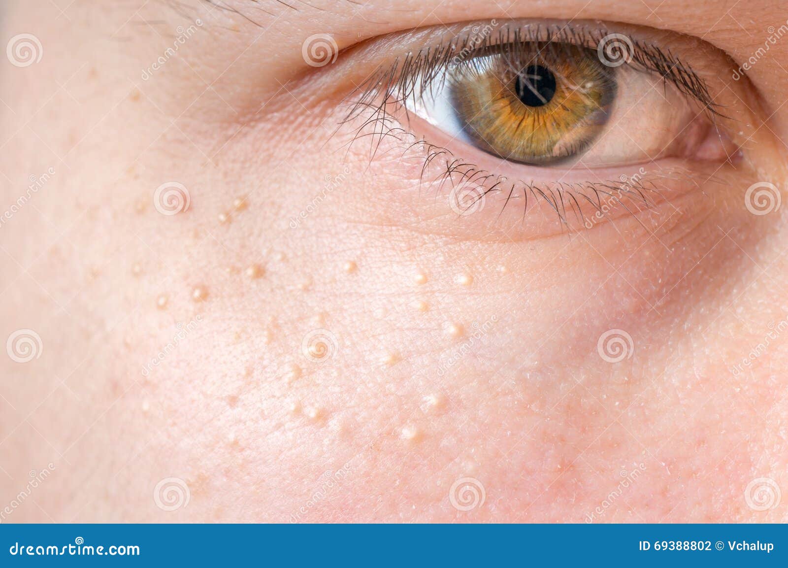 Milia (Milium) Pimples Around Eye on Skin Stock Photo Image of acne