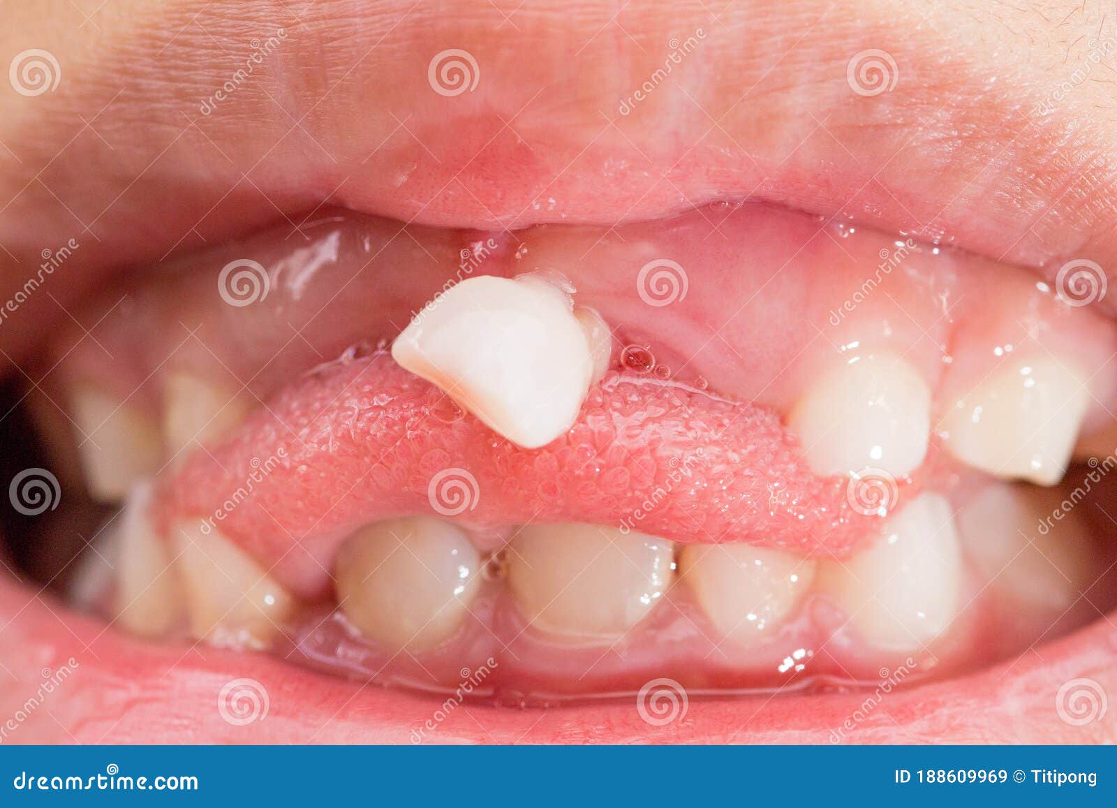 Milk Teeth that are about To Fall Stock Image - Image of happy, baby