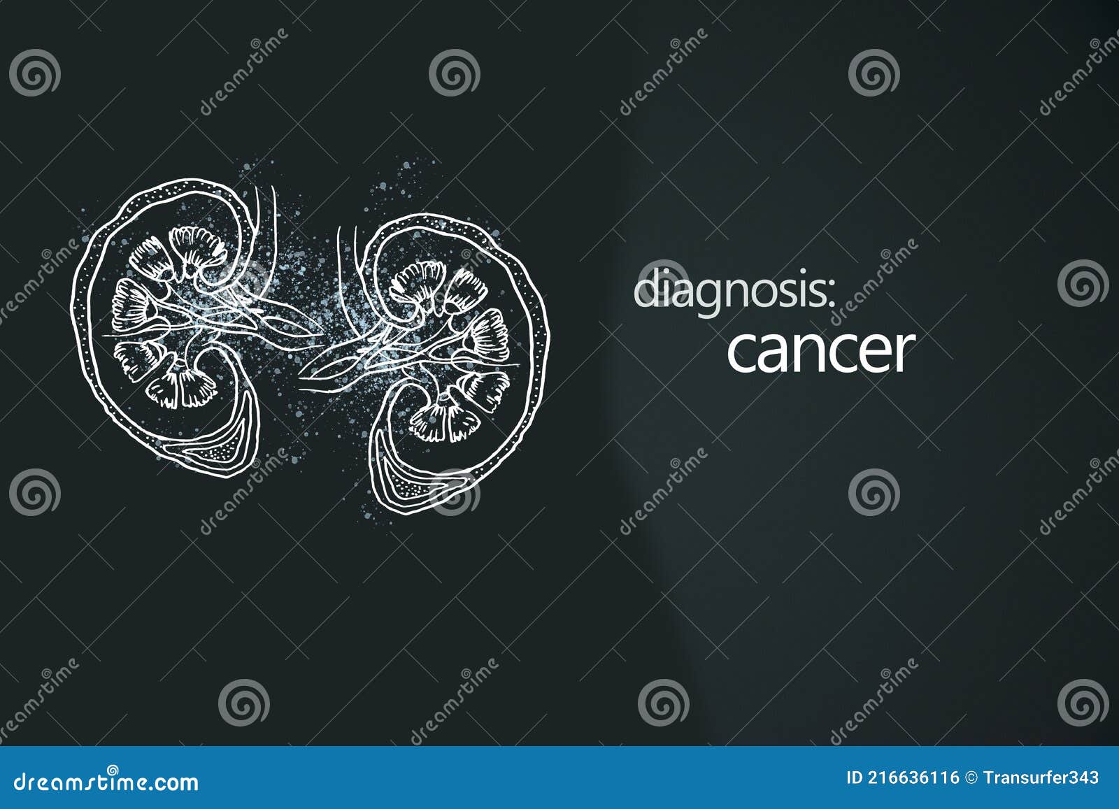 cancer kidney disease or renal cell carcinomas. malignant kidney tumors.