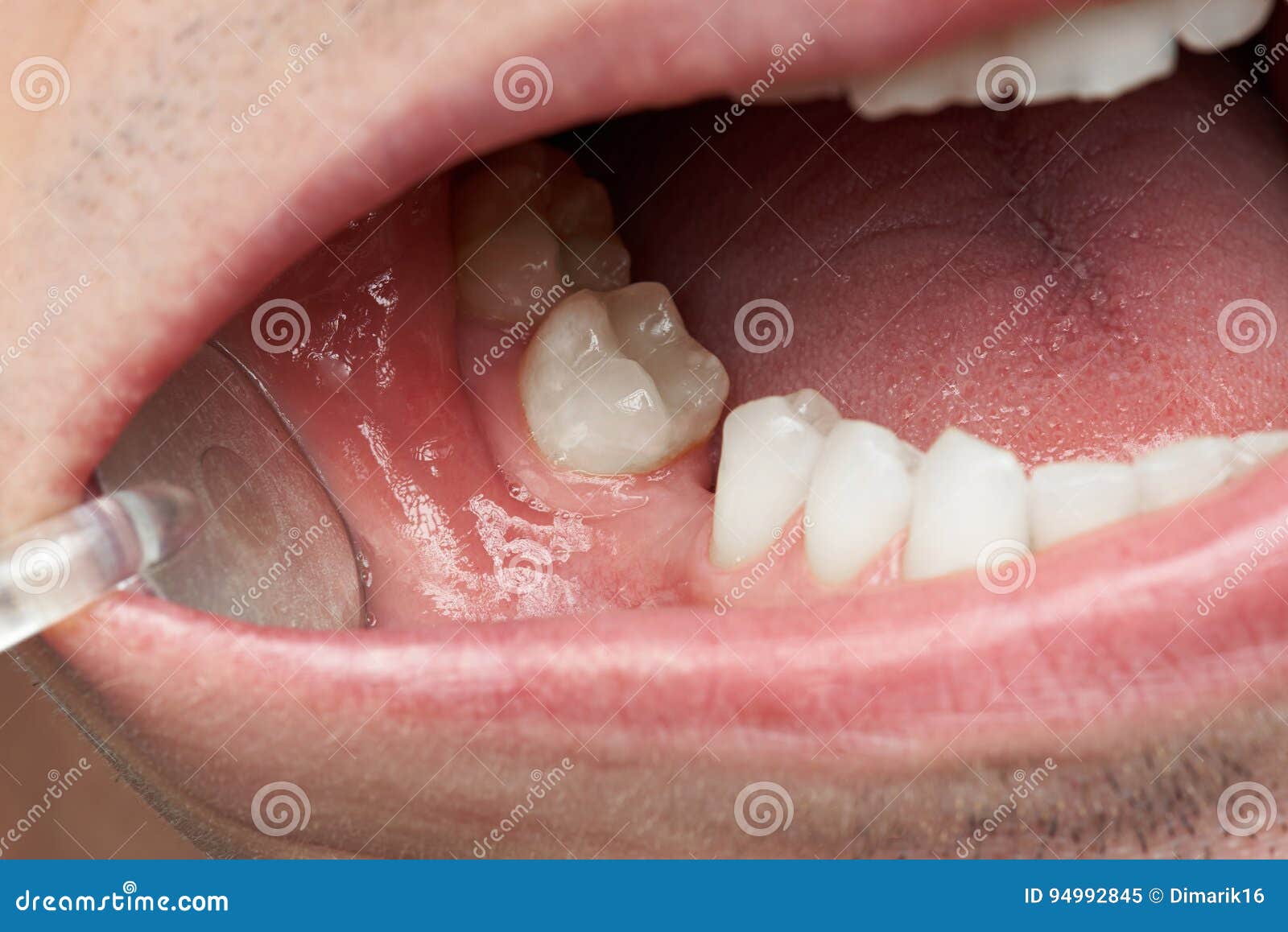 Missing tooth in man mouth stock image. Image of caucasian 94992845