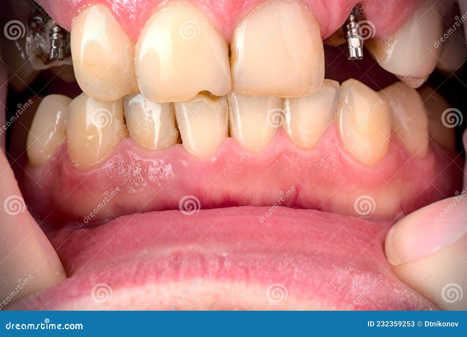 Missing Two Teeth in a Smoker Closeup. Stock Image Image of care