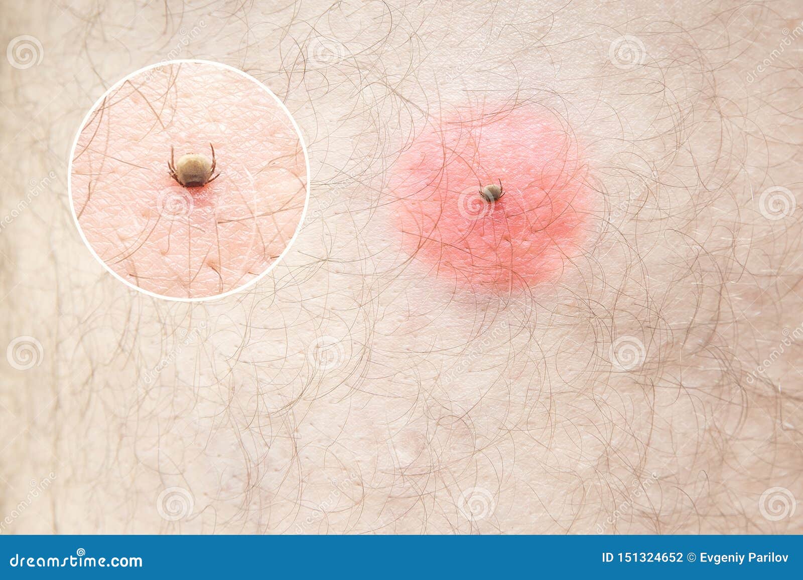 Mite Skin Bite Of The Human Body Macro Photo Stock Photo Image Of