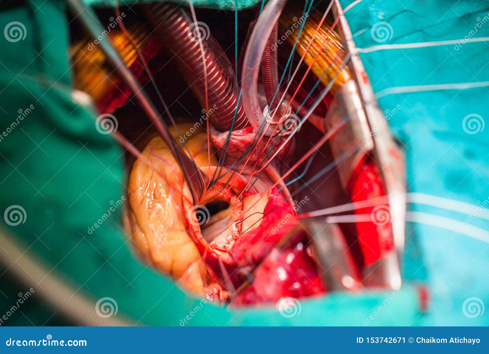 Potential and challenges of Transcatheter mitral valve implantation