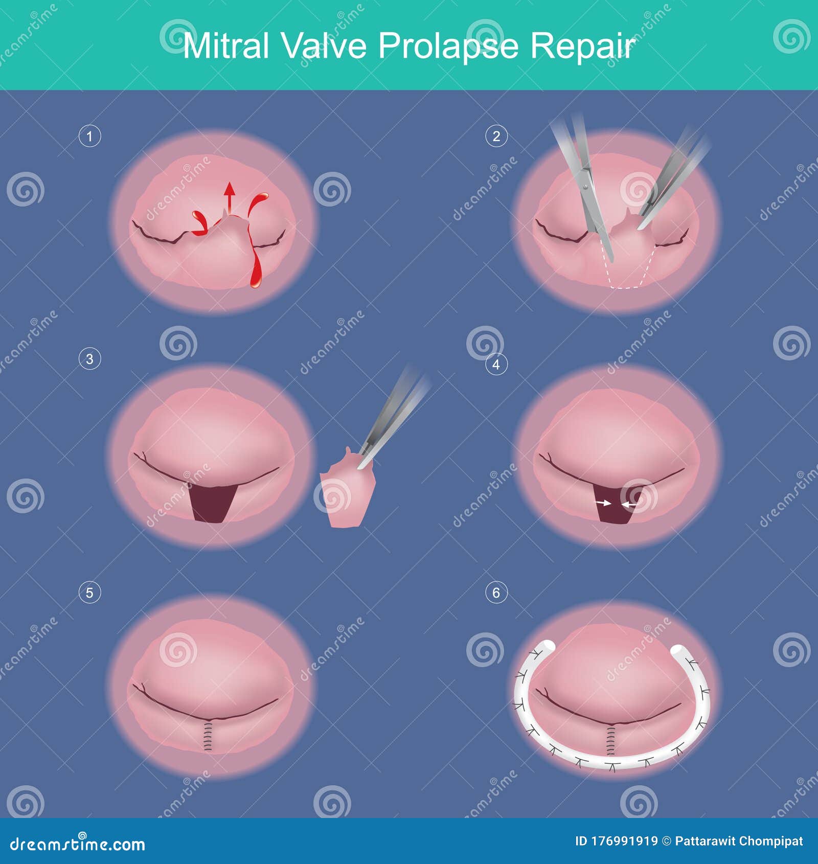 mitral valve prolapse repair. the method repair heart valve by surgery removed damaged or abnormal leaked segment and used
