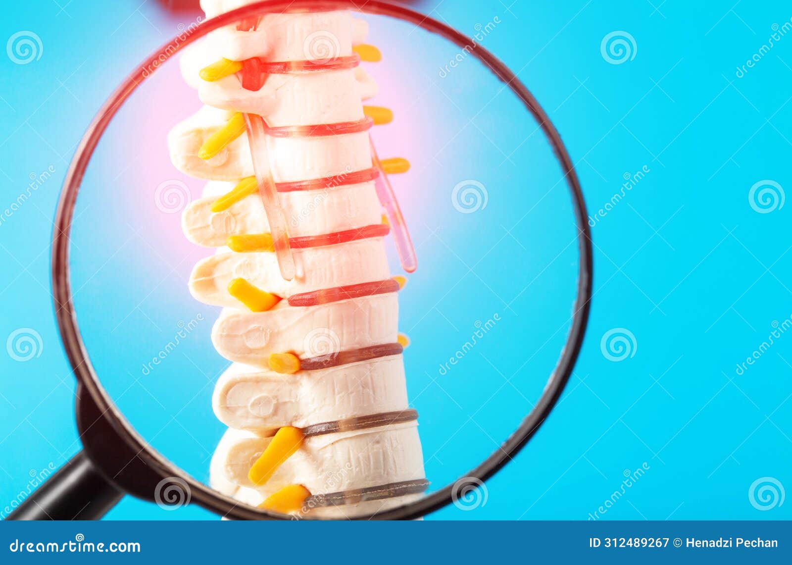 model of the cervical spine with a compressed nerve root on a blue background under a magnifying glass. concept of