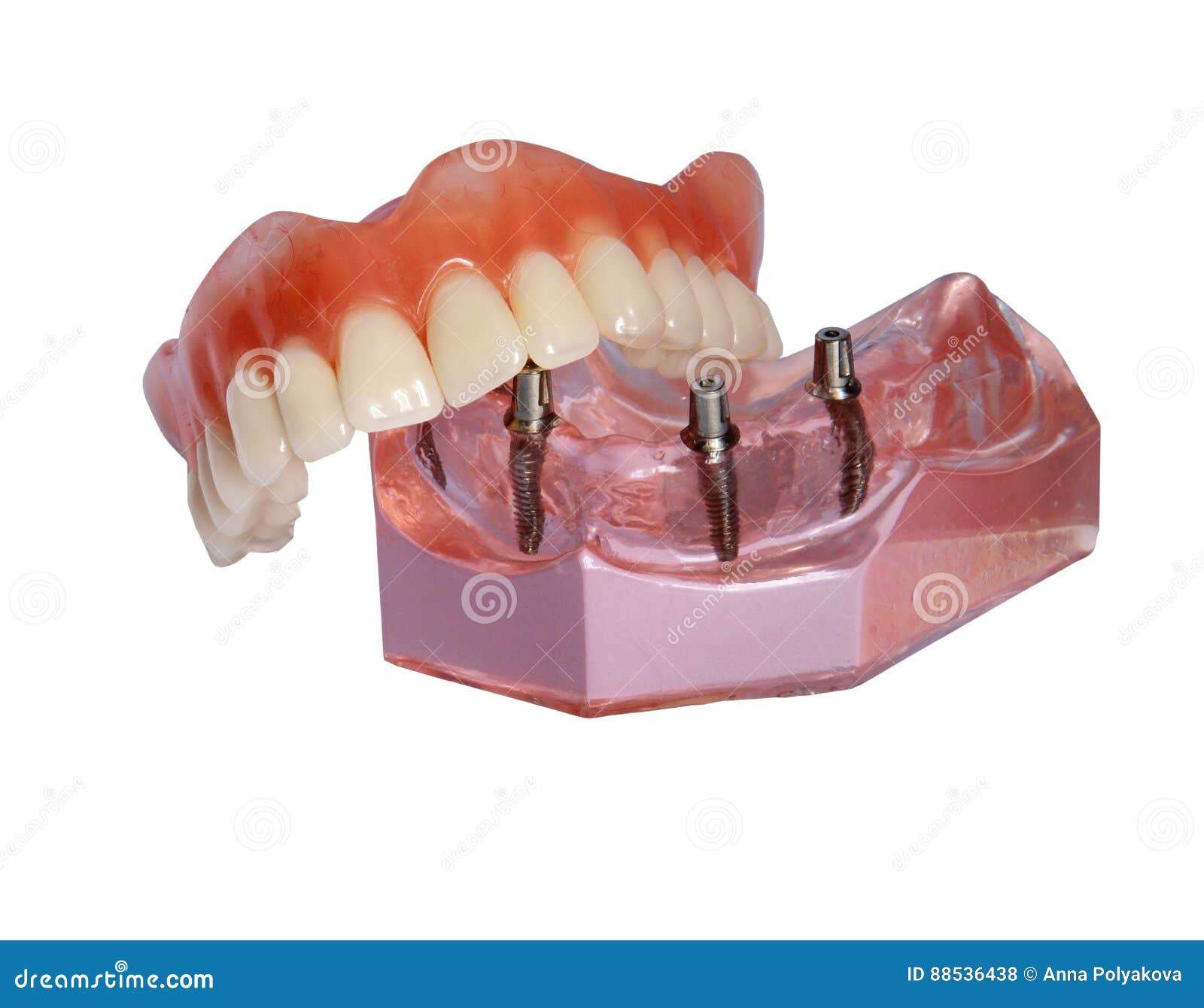 model of a jaw and denture 2