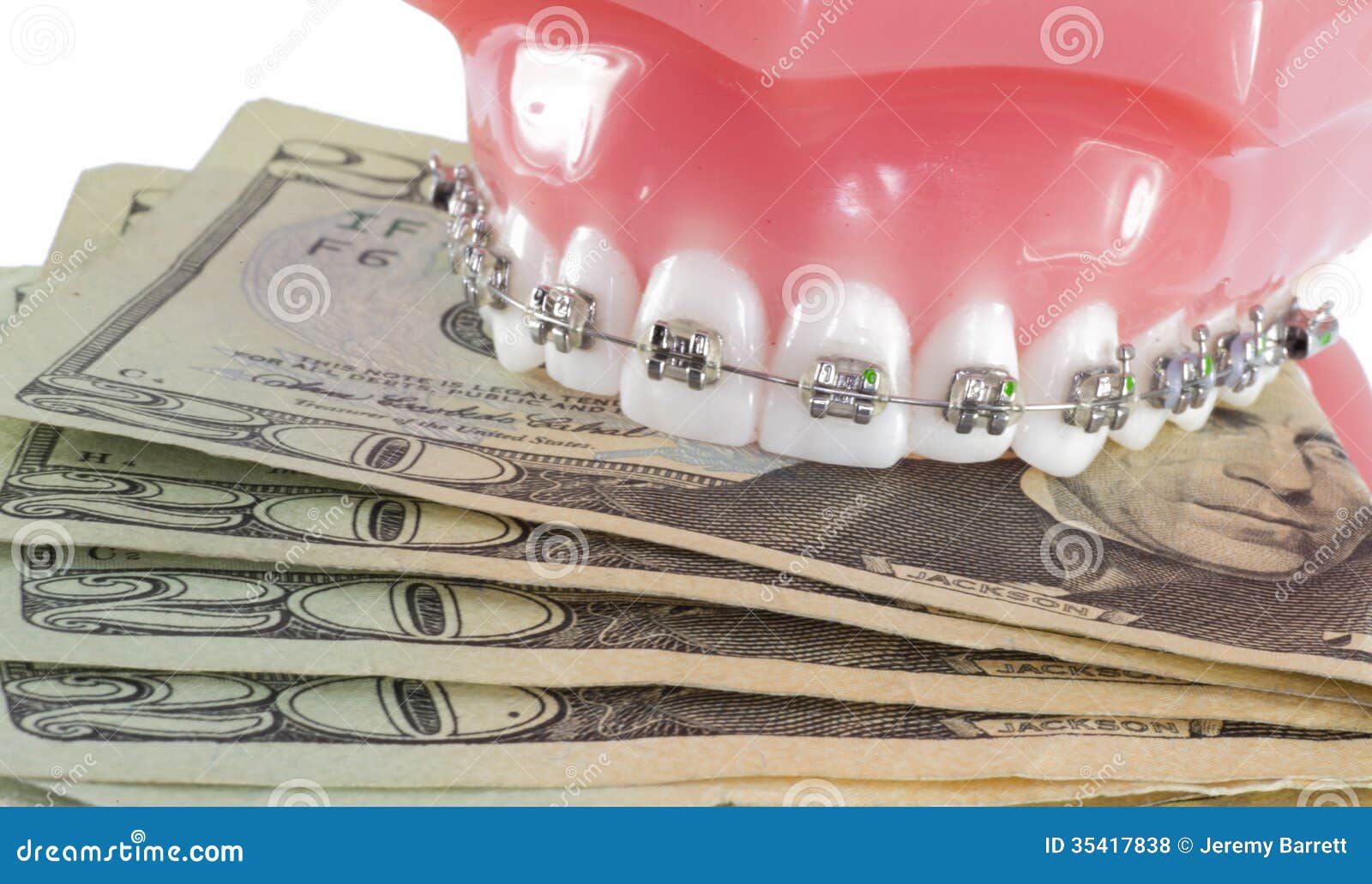 Model Of Teeth With Braces And Money Royalty Free Stock Photos Image