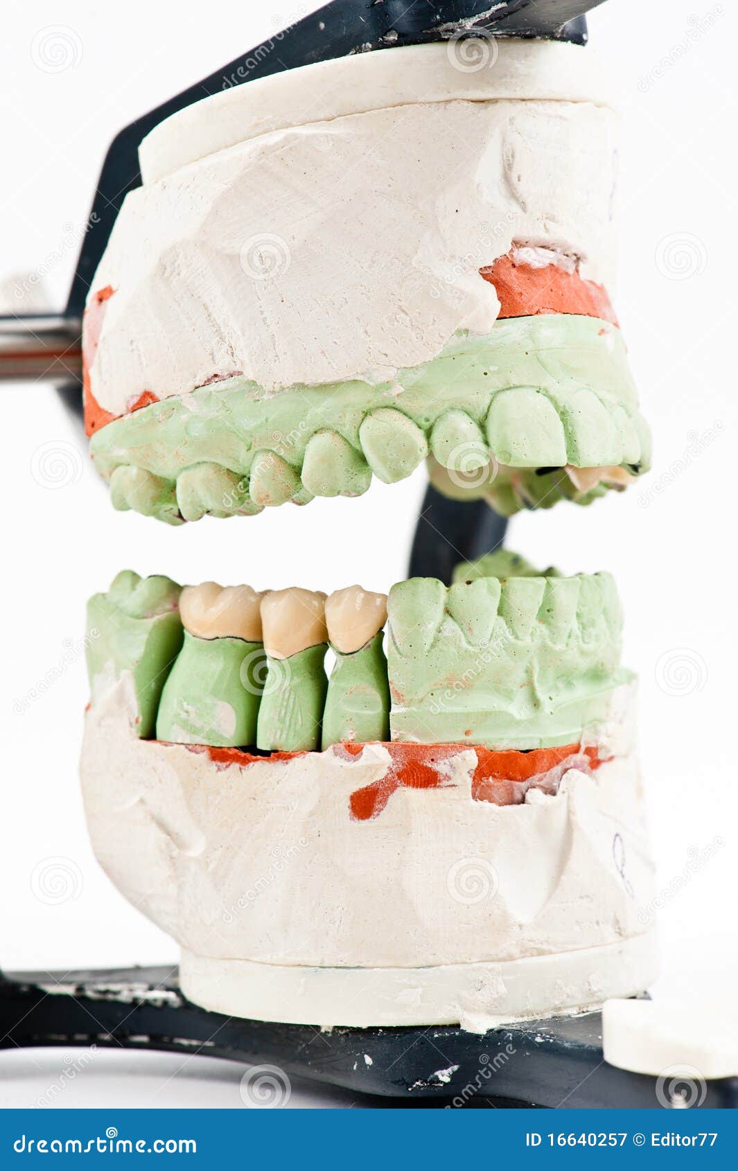 Attuali Tendenze Nel Rialzo Di Seno Mascellare Per Via Transalveolare - Foto 10