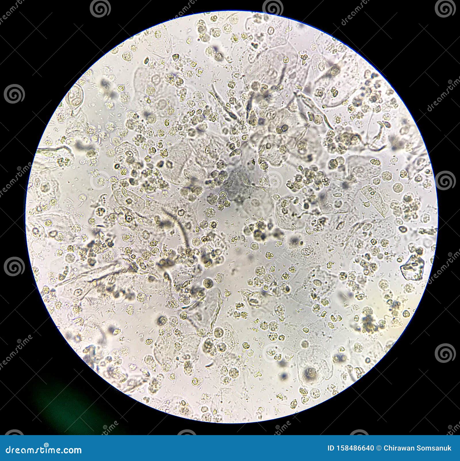 moderate bacteria and white blood cells in patien bacteria urinary tract infection