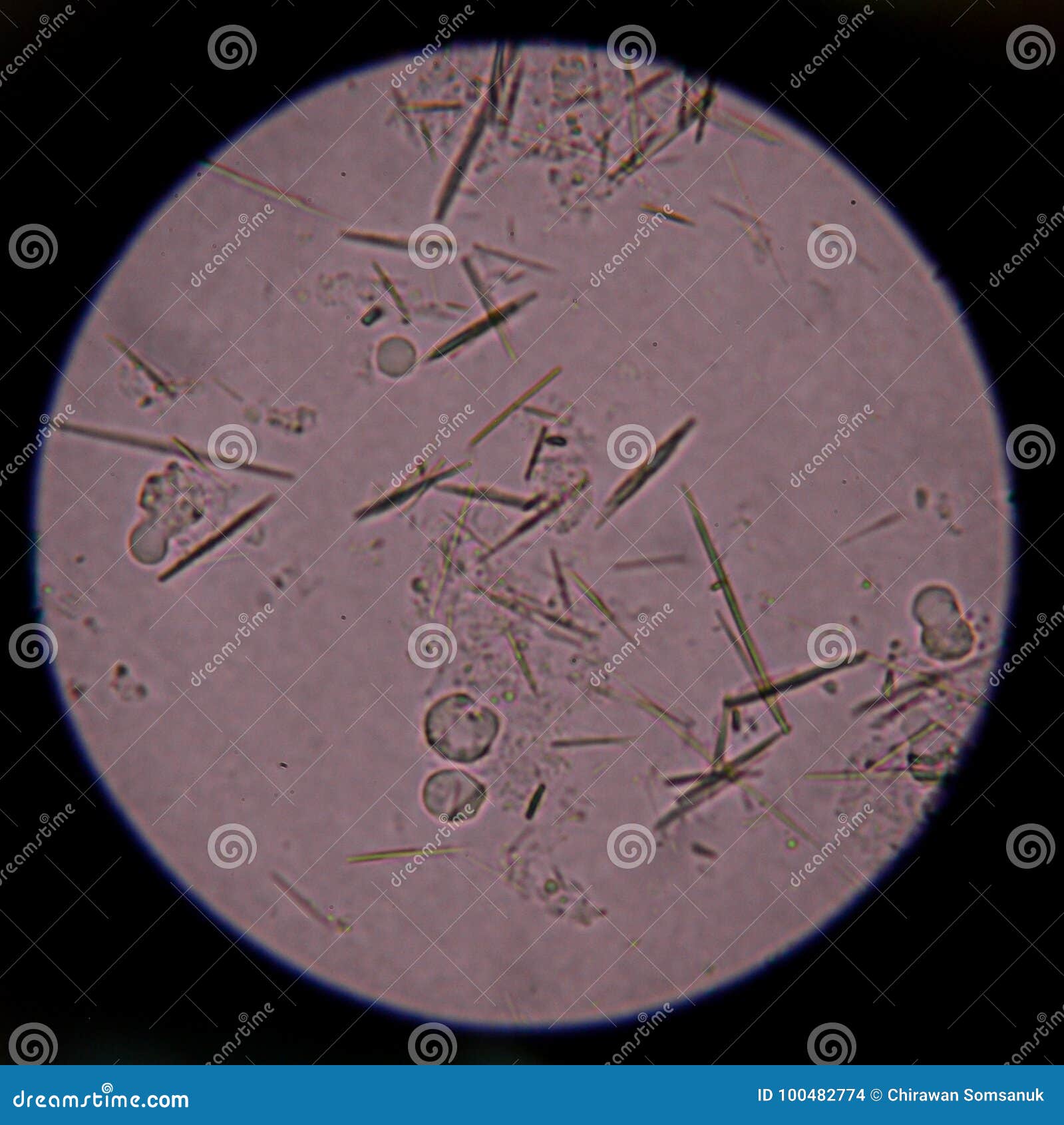 Moderate uric acid crystals in urine stock photography cartoondealer