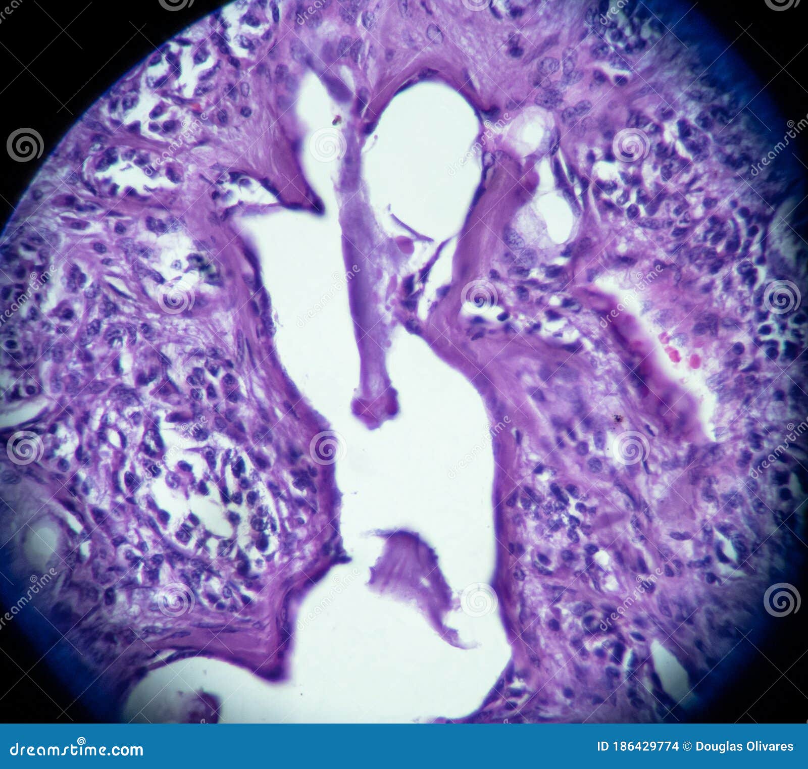 moderately differentiated neuroendocrine carcinoma atypical carcinoid