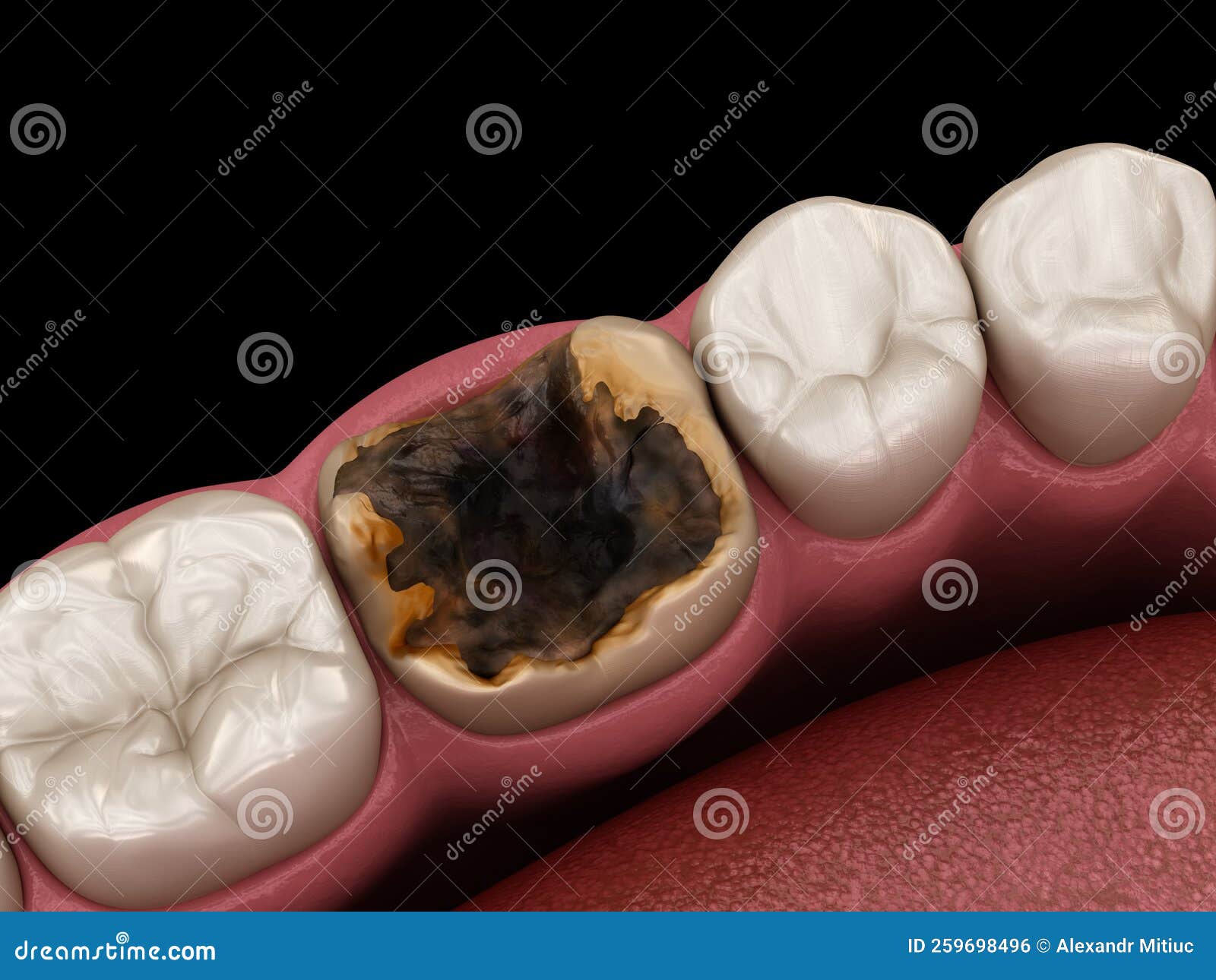 Molar Tooth Damaged by Caries. Medically Accurate Tooth 3D Illustration