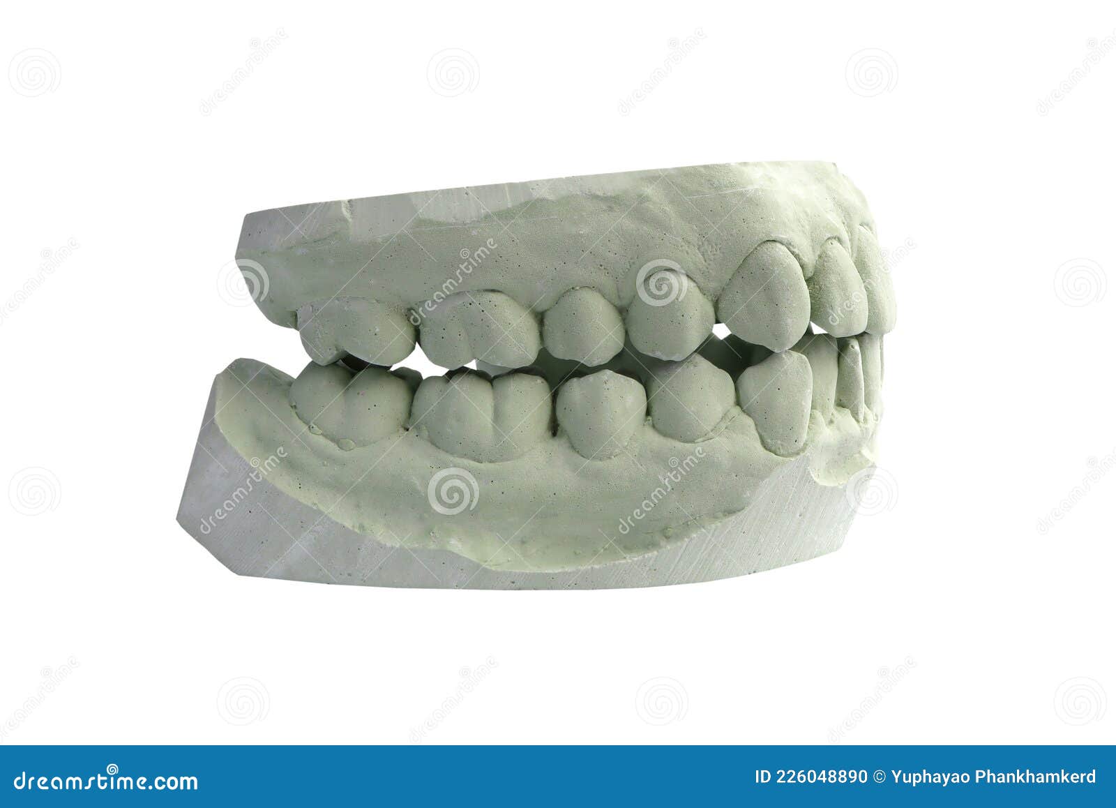 Mold Dental Model of Orthodontic Problems. Stock Photo Image of