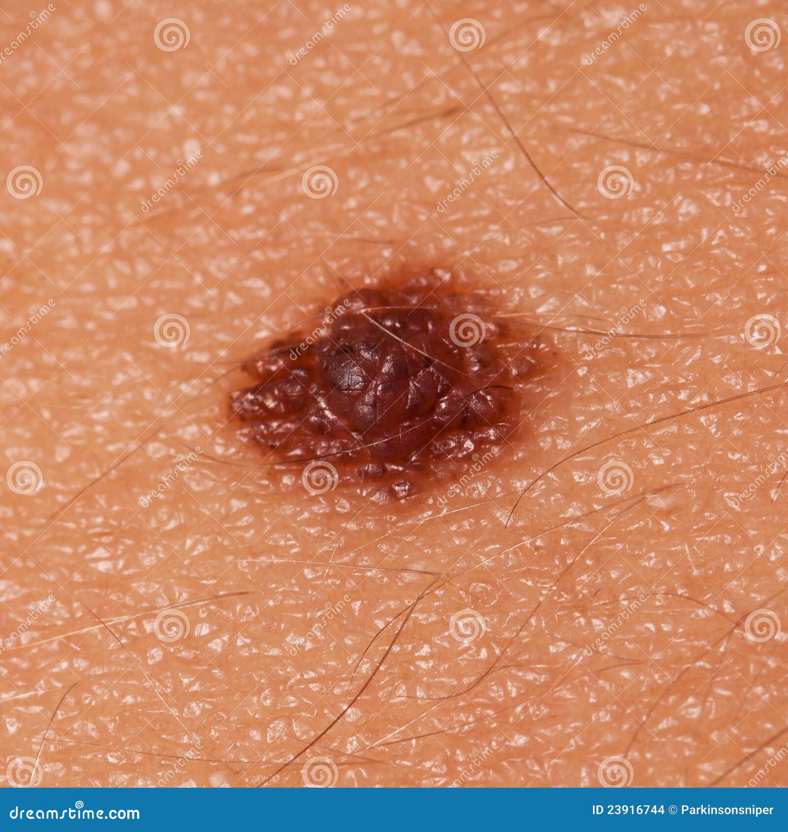 Definition of a Spitz Nevus - Verywell