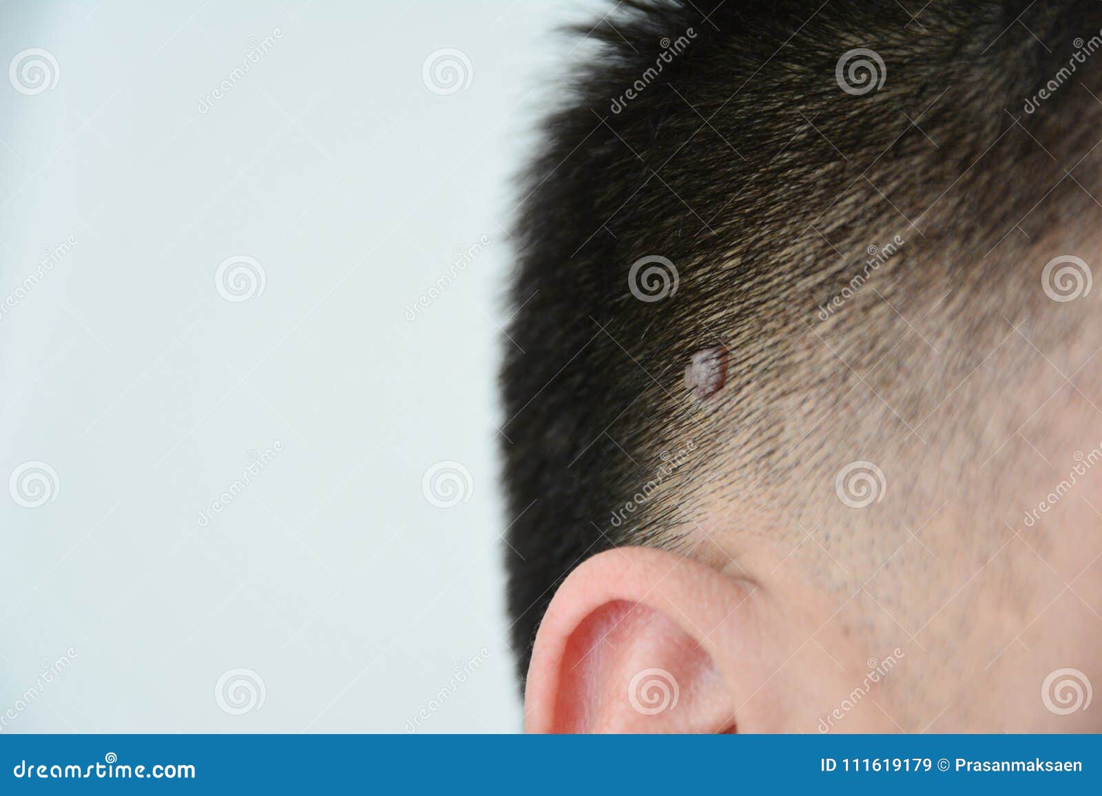 Mole or wart stock image. Image of danger, isolated - 111619179