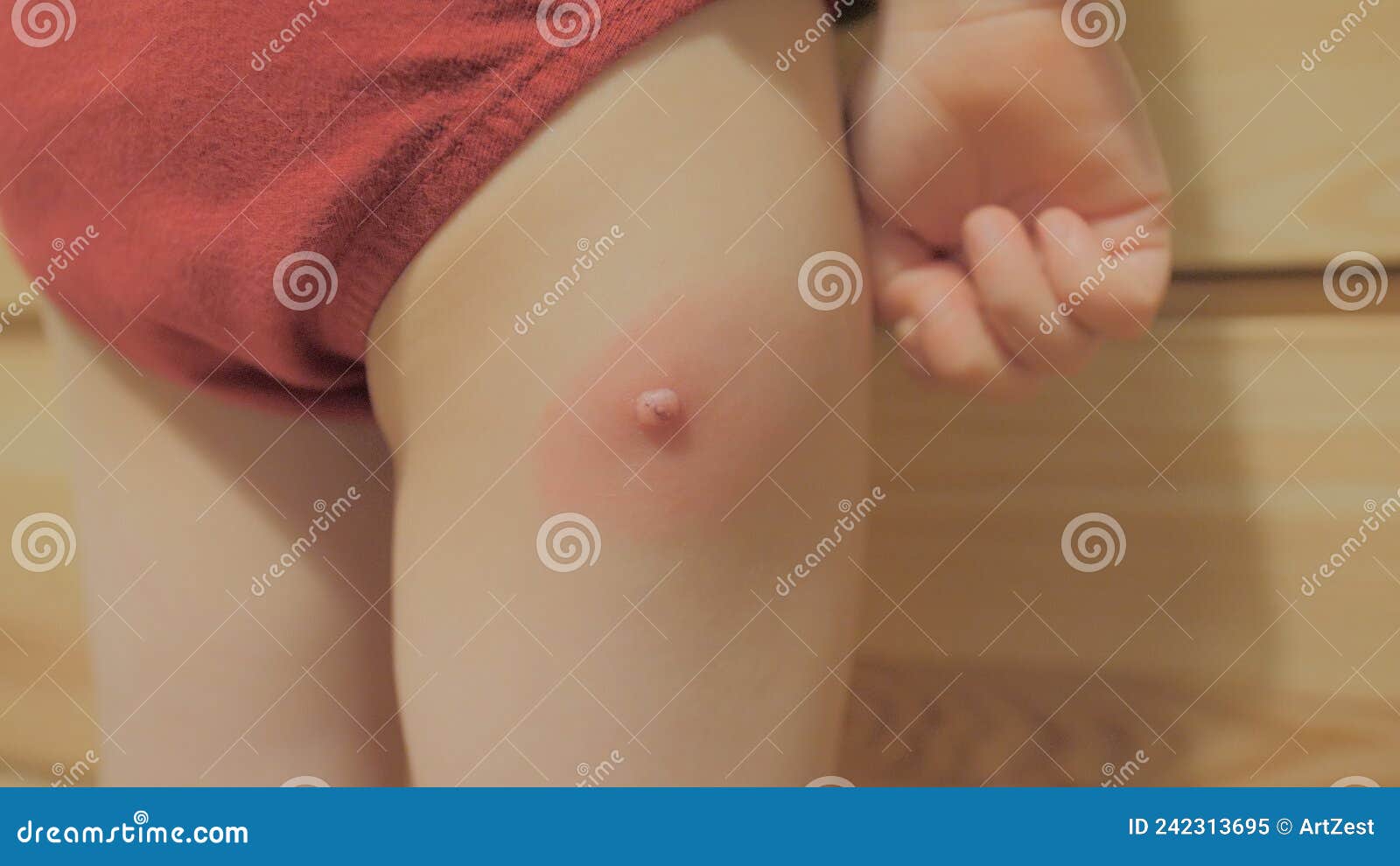 Mollusque Infecté Contagiosum Rougeur Enflée Jambe D'un Enfant De ...