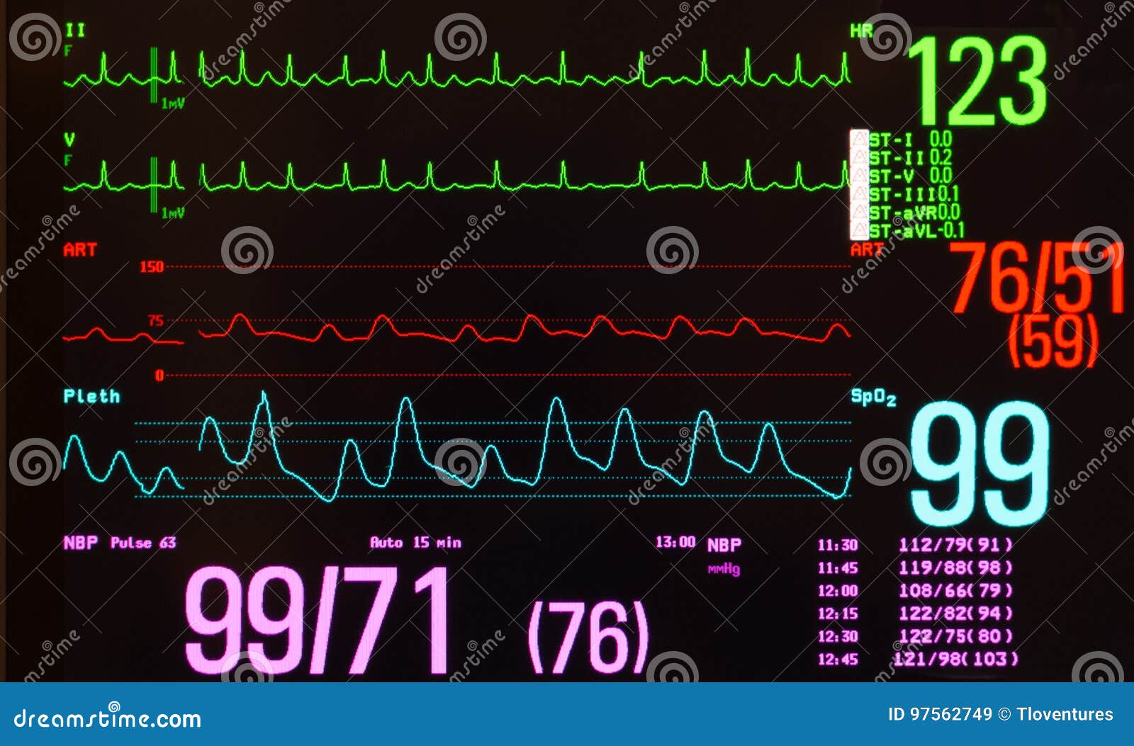 monitor with atrial flutter