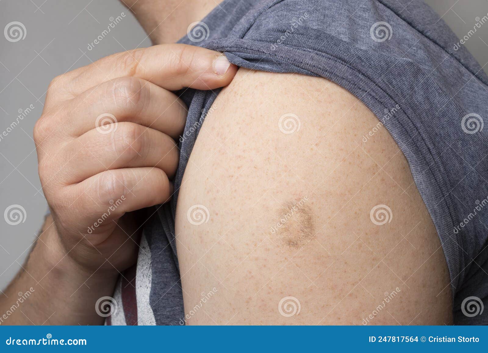 monkeypox and smallpox vaccine scar on young man`s arm