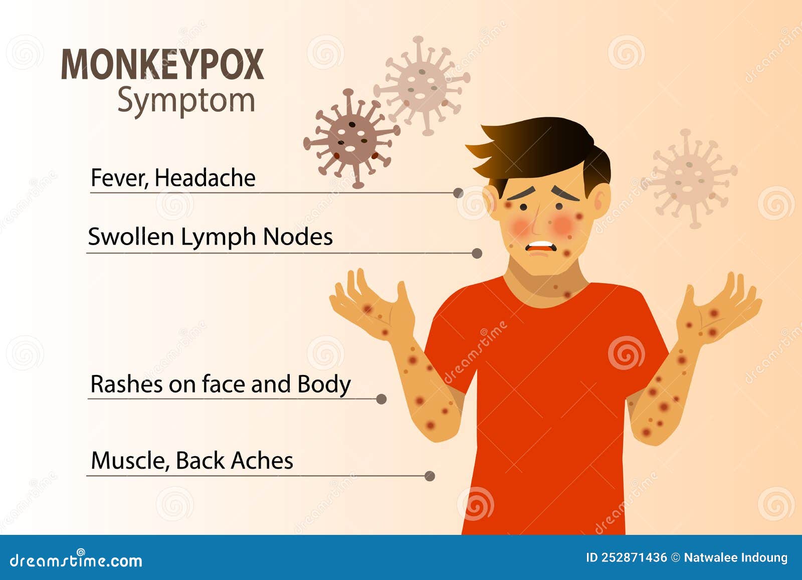 monkeypox virus symptom infographic on patient with fever, headache, swollen lymph node, rashes on face, body and back, muscle