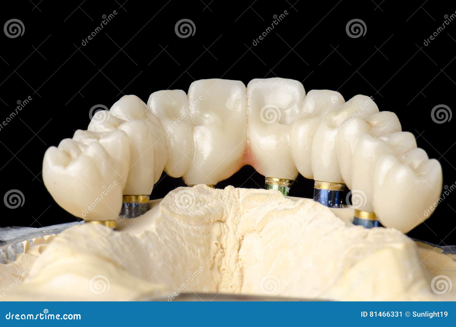 Monolithic Zirconia Restorations Implant Supported With The Cer Stock
