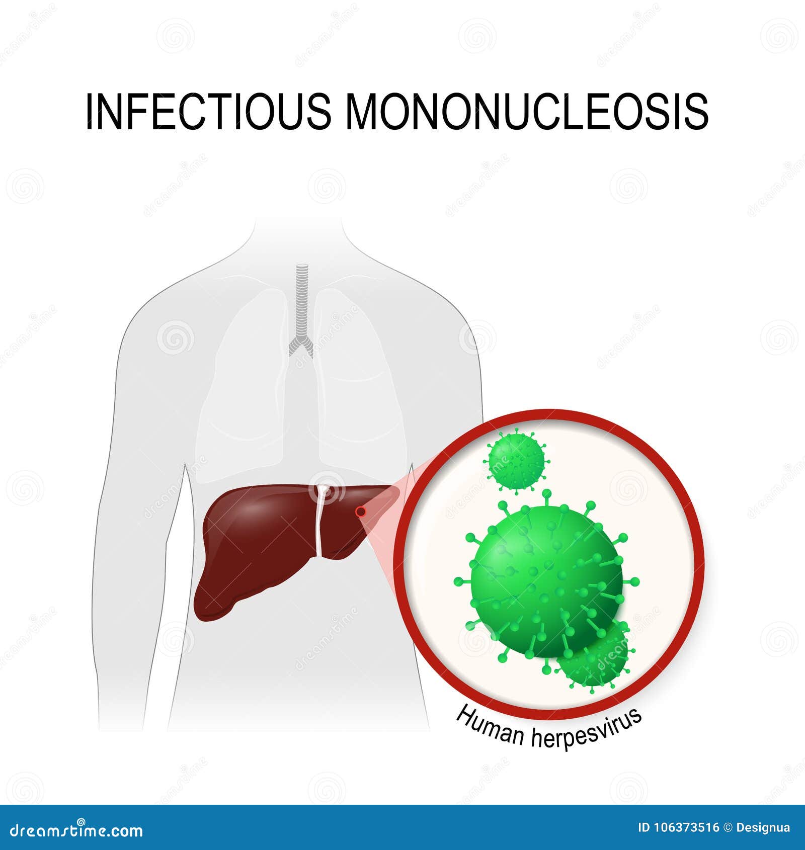 Mononucléose Infectieuse Herpevirus Humain Illustration de Vecteur ...