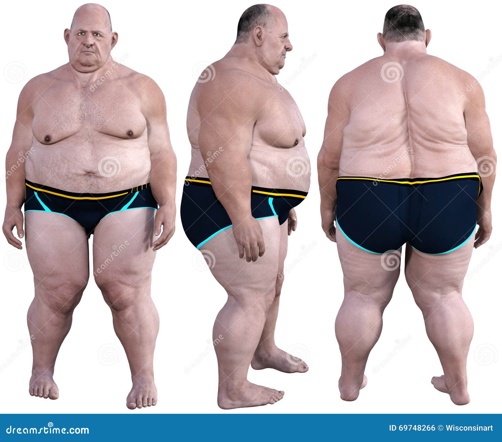 morbidly obese, overweight, obesity, 