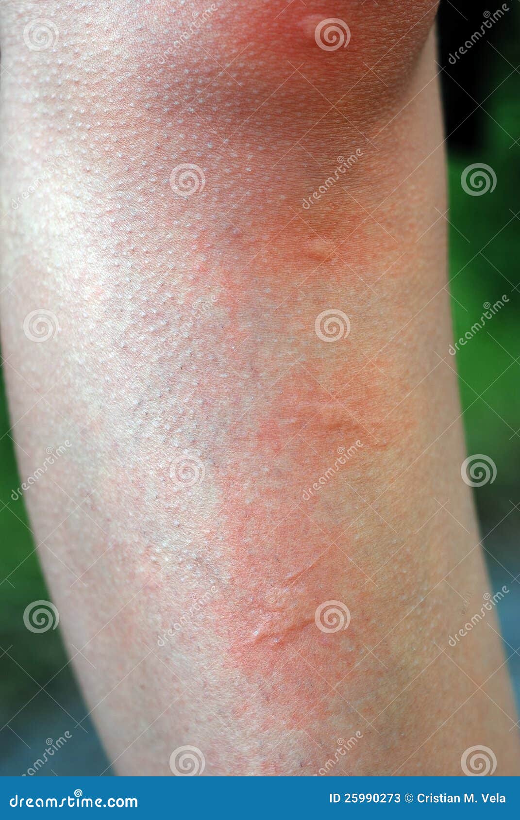 Morso di zanzara sul particolare del primo piano del piedino