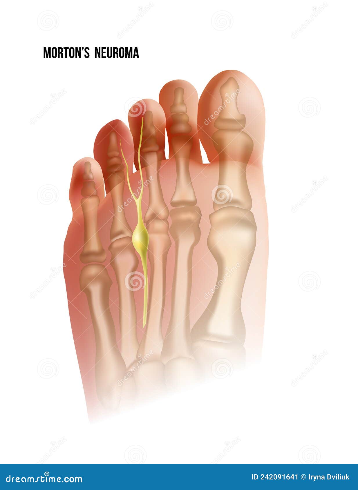 mortons neuroma. foot pain strain bottom view. realistic anatomy 
