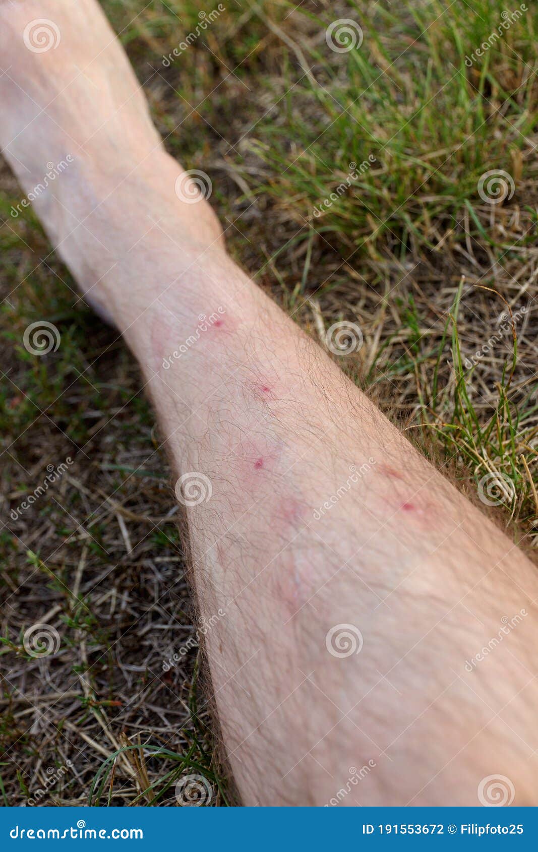 Mosquito bites stock photo. Image of bites, mosquito 191553672