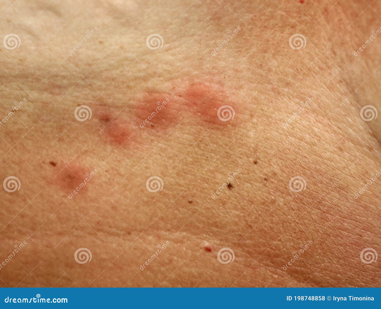 Mosquito Bites on the Skin Under the Breast Stock Photo - Image of