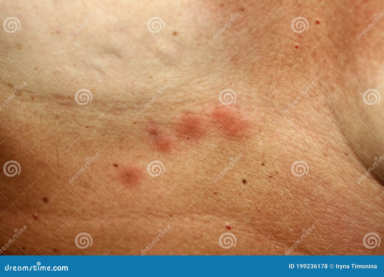 Mosquito Bites on the Skin Under the Breast Stock Photo - Image of female,  health: 199236178