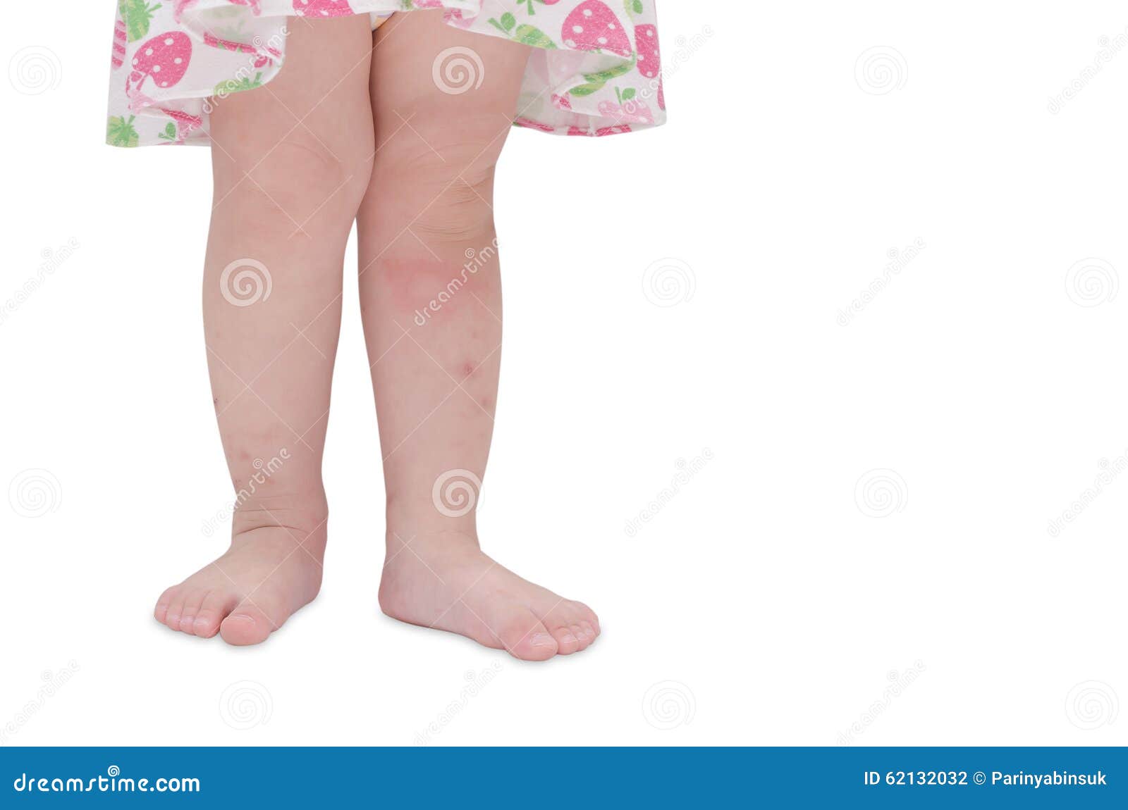 Mosquito Bites Sore on Baby Legs Stock Photo Image of face, infection