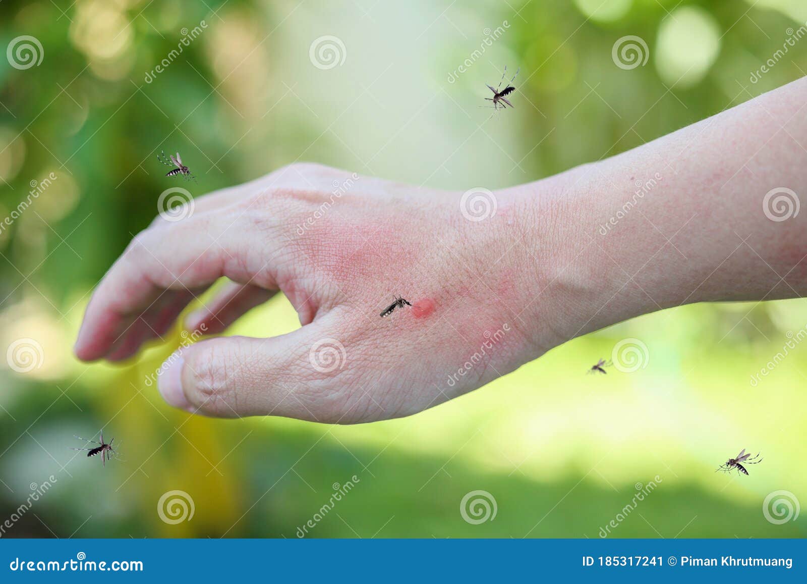 Mosquitoes Bite On Adult Hand Made Skin Rash And Allergy With Red Spot