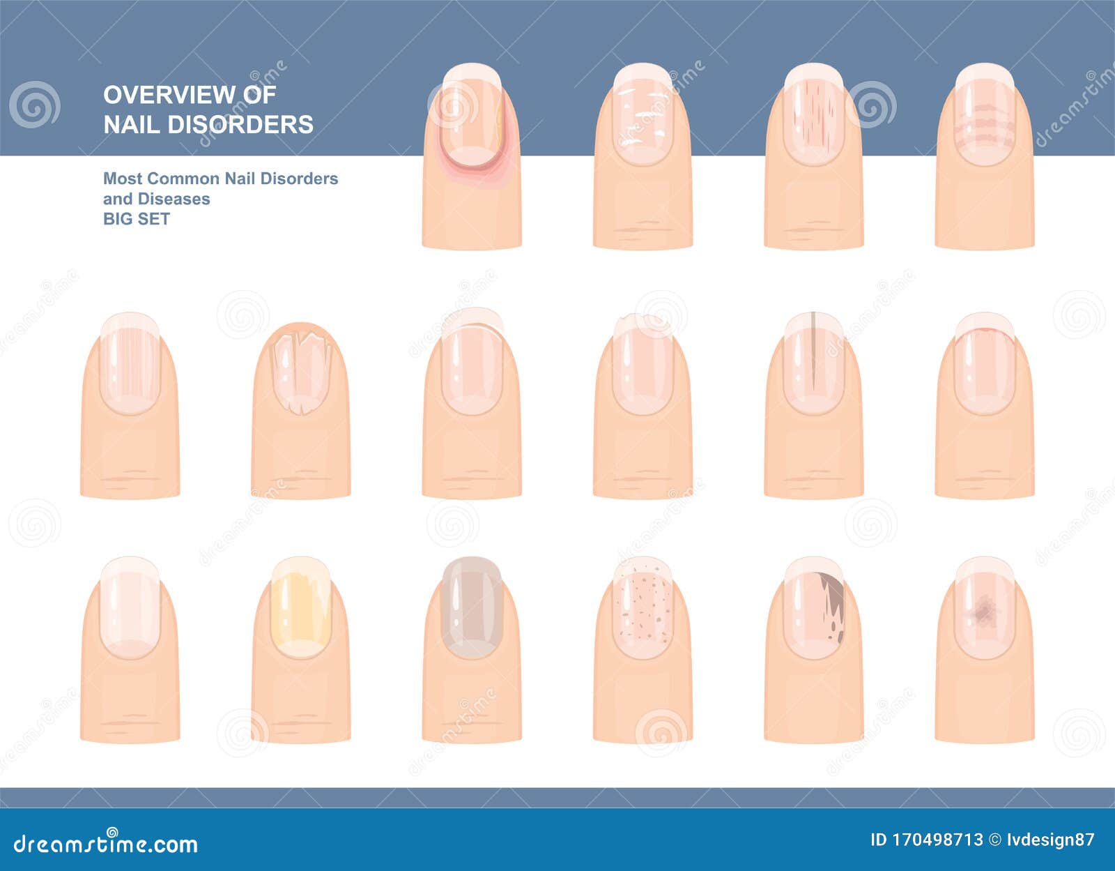 Most Common Nail Disorders and Diseases. Big Set. Vector Illustration Stock Vector - Illustration of fingernail, ailment: 170498713 Most Common Nail Disorders and Diseases. Big Set. Vector Illustration Stock Vector - Illustration of fingernail, ailment: 170498713