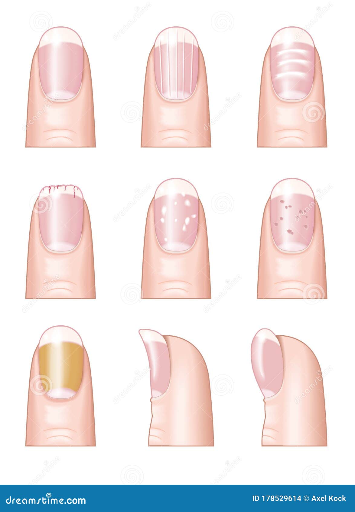 White Spots Nails Stock Illustrations – 20 White Spots Nails Stock Illustrations, Vectors & Clipart - Dreamstime White Spots Nails Stock Illustrations – 20 White Spots Nails Stock Illustrations, Vectors & Clipart - Dreamstime