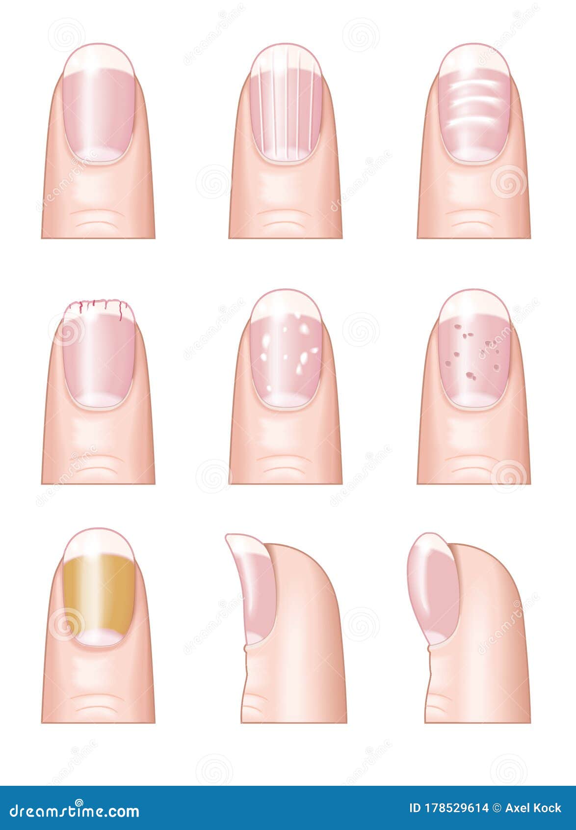 What Are White Spots On Nails and How To Get Rid of Them?