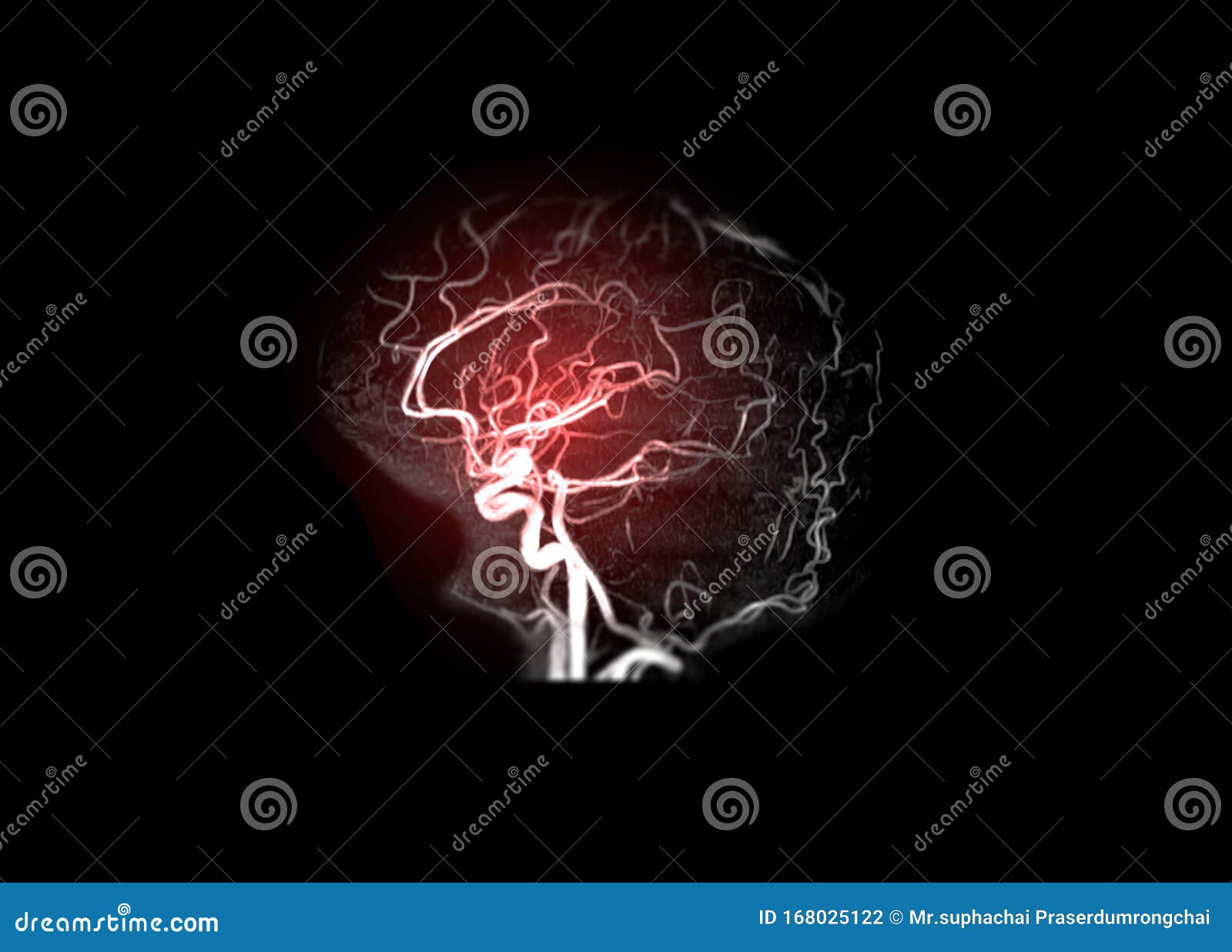 mra brain or magnetic resonance angiography image  mra  of cerebral artery in the brain .